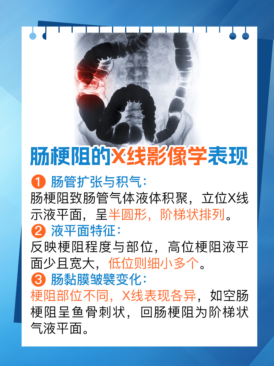 肠梗阻X线影像揭秘:快速识别典型征象