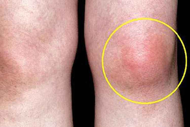 膝关节骨膜炎局部肿胀、疼痛图