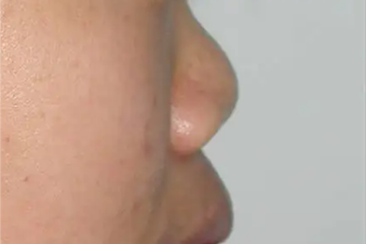 萎缩性多软骨炎鼻部畸形图 萎缩性多软骨炎鼻部畸形图