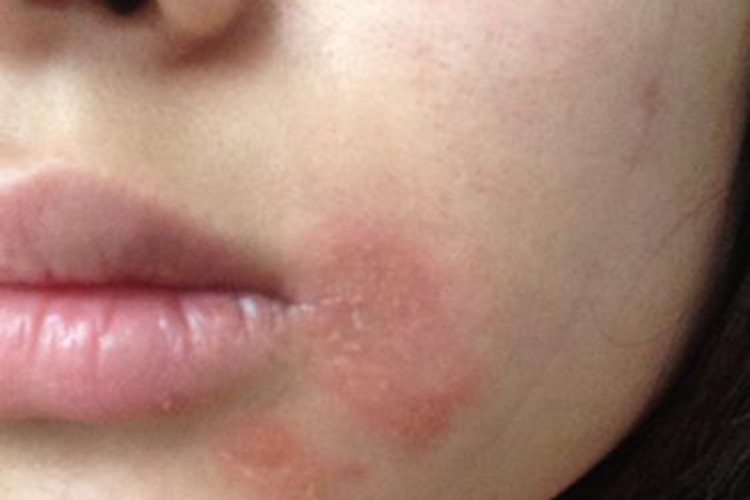 接触性口角炎口周红斑图 接触性口角炎口周红斑图