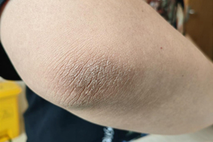 黑棘皮病肘部皮肤粗糙图