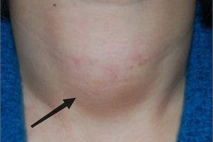 桥本甲状腺炎大包图