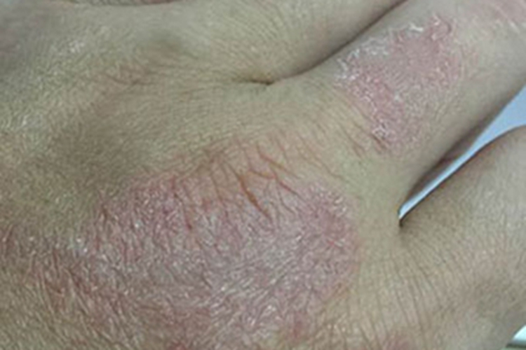 手部湿疹手背粗糙发红图