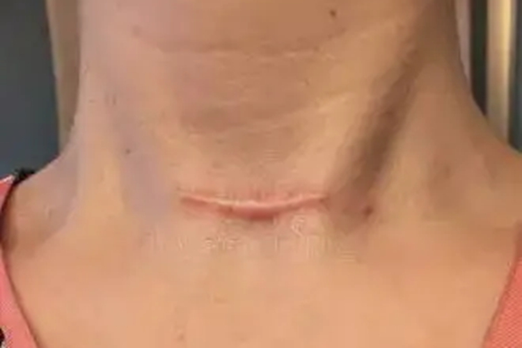 甲状腺手术瘢痕图 甲状腺手术瘢痕图