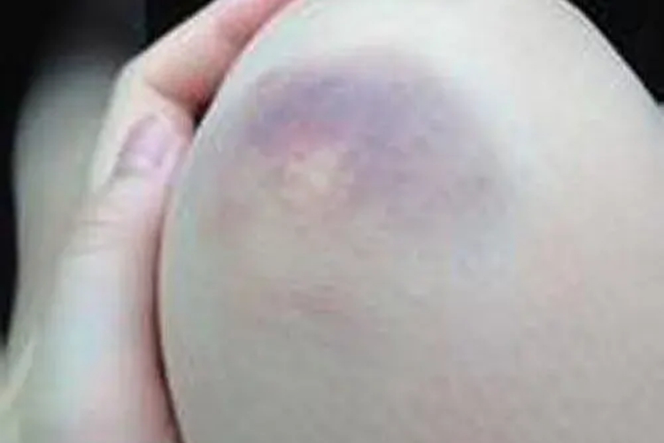 膝盖外伤性紫块图