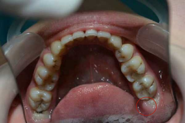 拔完智齿有个白色软肉图