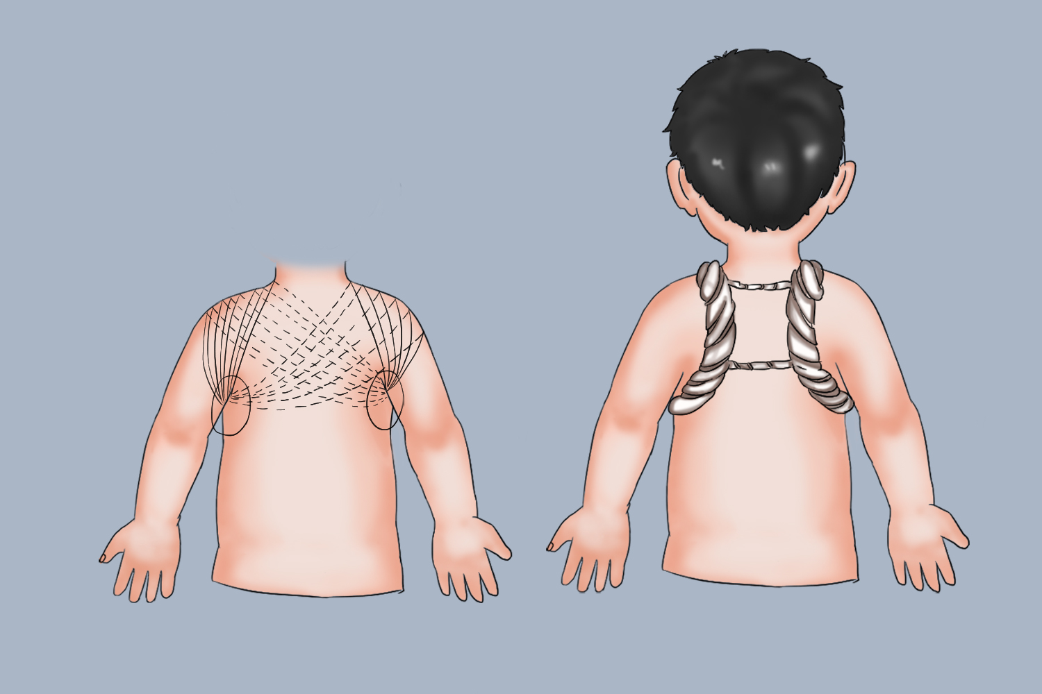 “8”字绷带固定法图