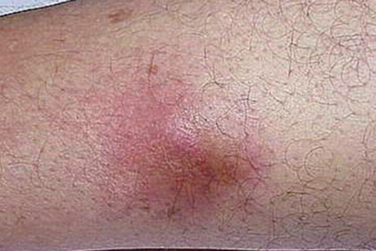 皮肤非典型分枝杆菌病小腿结节图