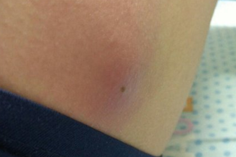 大腿外侧疖肿图