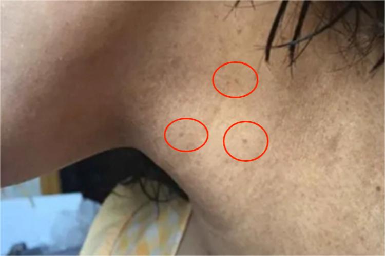 皮肤黑变病颈部斑图