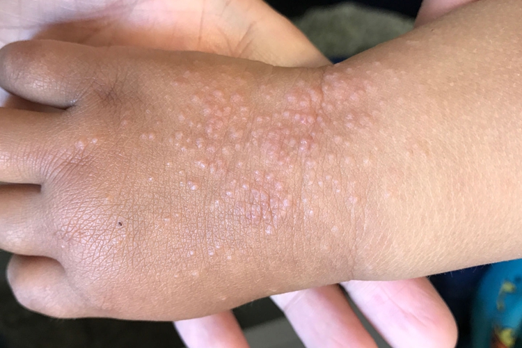摩擦性苔藓样疹图