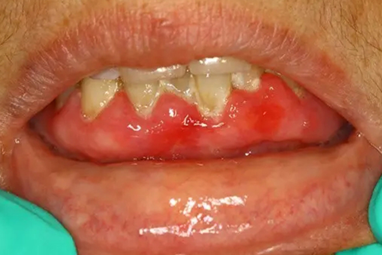 黏膜类天疱疮图