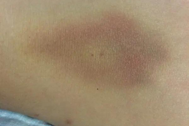 手背外伤发紫图 手背外伤发紫图