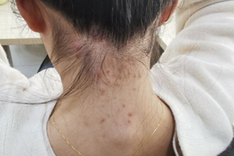 项部瘢痕疙瘩性毛囊炎小疙瘩图