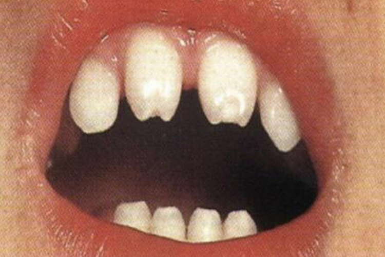 先天性梅毒牙图 先天性梅毒牙图
