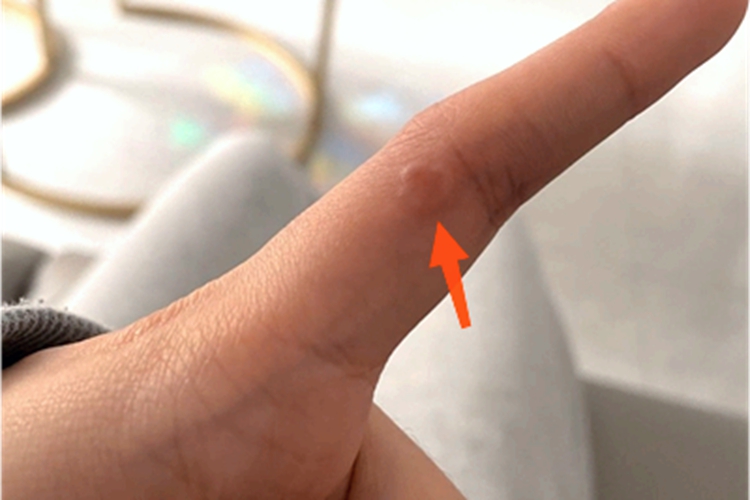 环状肉芽肿手指疙瘩图