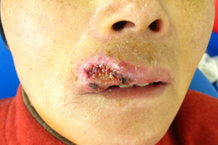 唇缺损嘴唇结痂图 唇缺损嘴唇结痂图