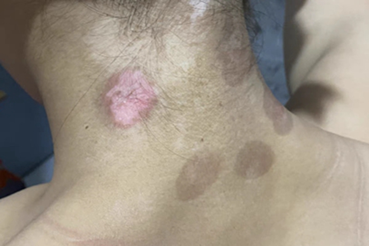 进展期节段型白癜风后颈白斑图 进展期节段型白癜风后颈白斑图