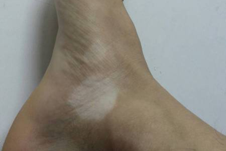 白色糠疹图 白色糠疹图