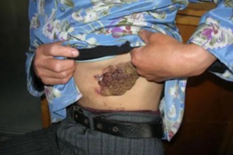 鲍温病左腹症状图 鲍温病左腹症状图