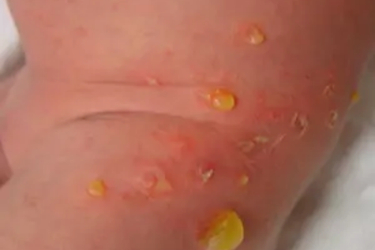 新生儿脓疱疮水疱图