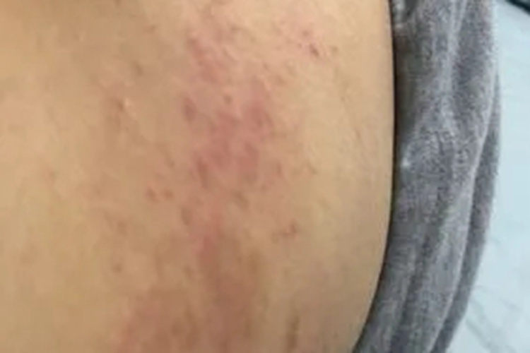 胯部湿疹图 胯部湿疹图