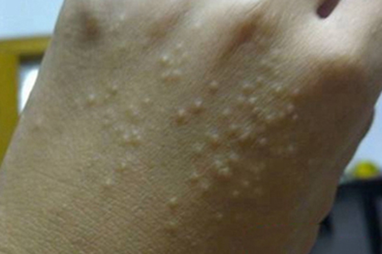 手部湿疹手背长许多小疙瘩图