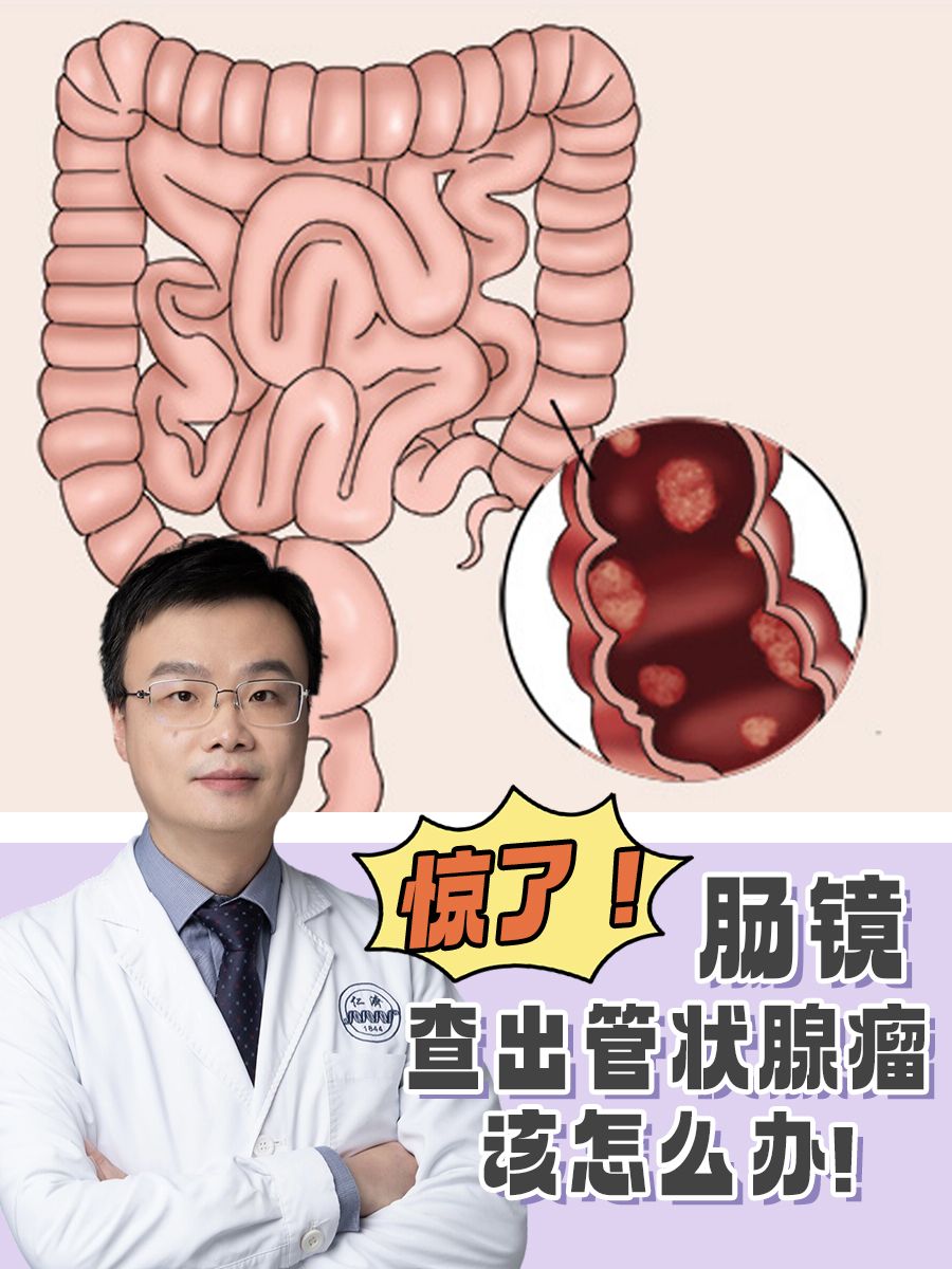 惊了!肠镜查出管状腺瘤,该怎么办!