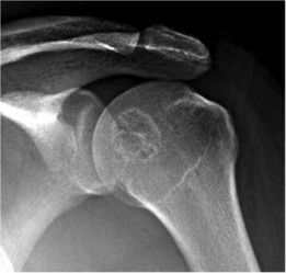 肩部软骨母细胞瘤影像学检查图 肩部软骨母细胞瘤影像学检查图