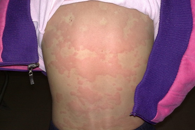 急性自发性荨麻疹背部红斑图