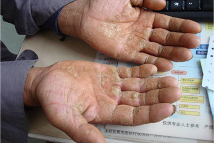 慢性苔藓样角化病手掌皮肤增厚图