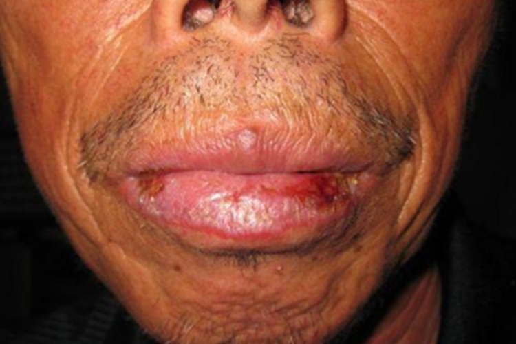 盘状红斑狼疮嘴唇症状图