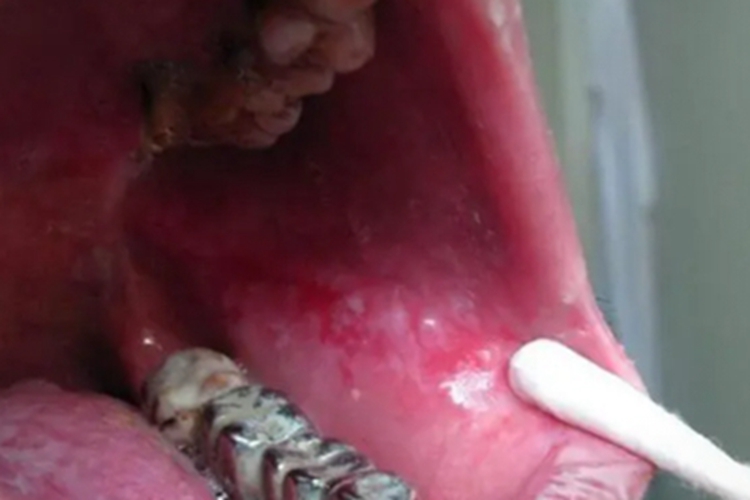 间杂型口腔红斑症状图