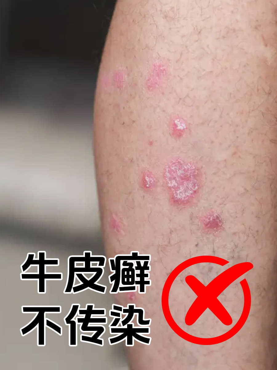 接触牛皮癣会传染吗？彻底打破你的顾虑！