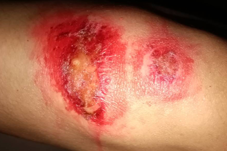 膝盖擦伤结痂化脓图 膝盖擦伤结痂化脓图