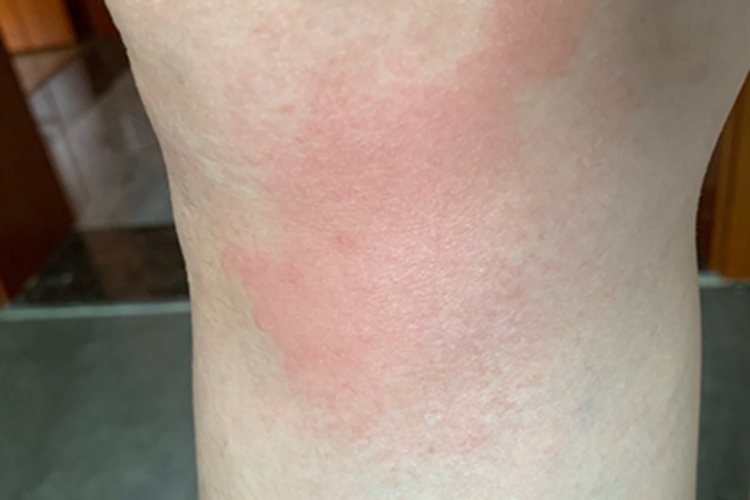 巴尔通体病小腿症状图