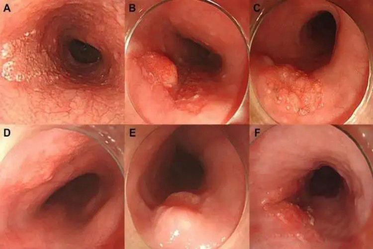 食道鳞状细胞癌图