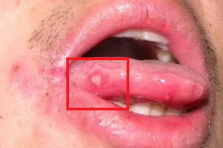 口腔梅毒舌头症状图