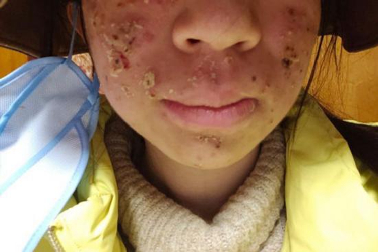 痘痘干燥脱屑图