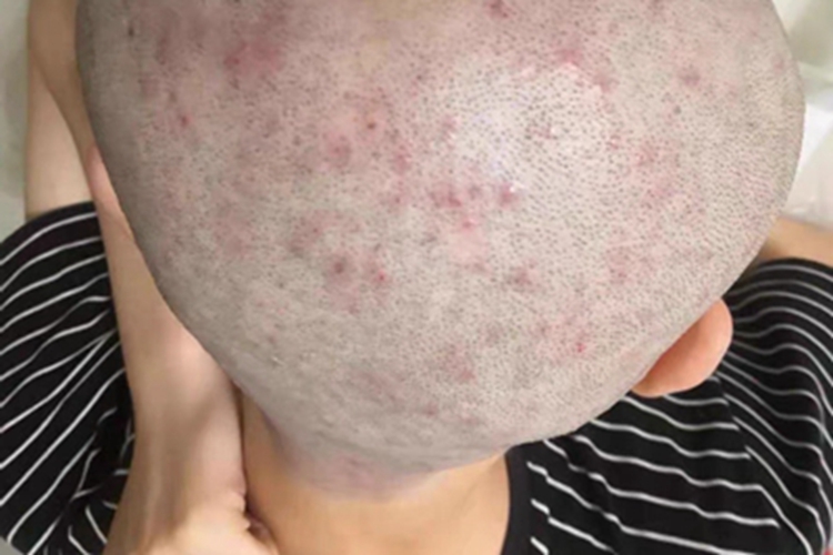 毛囊炎头皮长满了小红疙瘩图