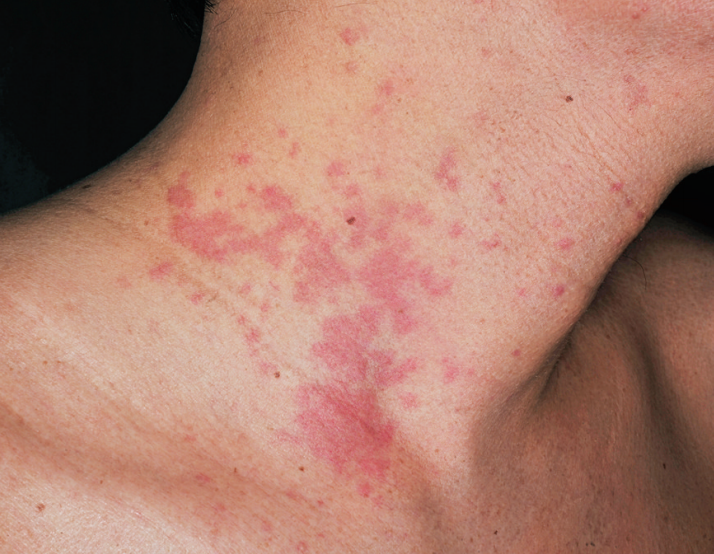 螨虫皮炎症状图