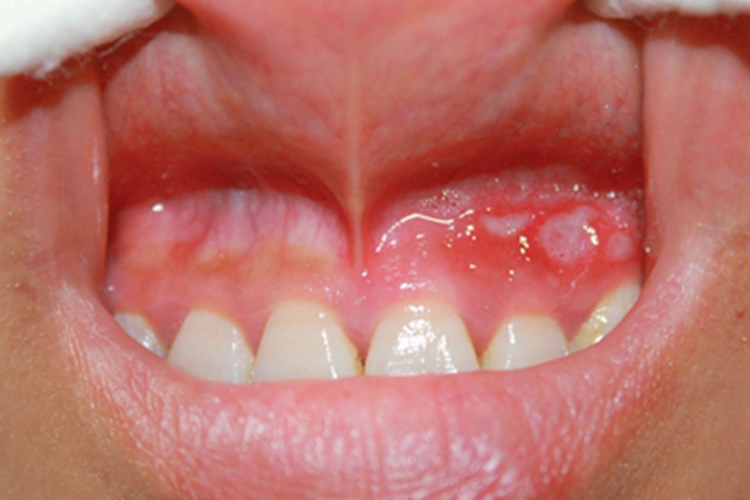 白塞病牙龈溃疡图