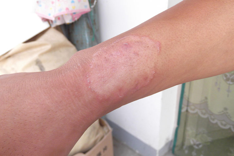 四肢体癣初期图