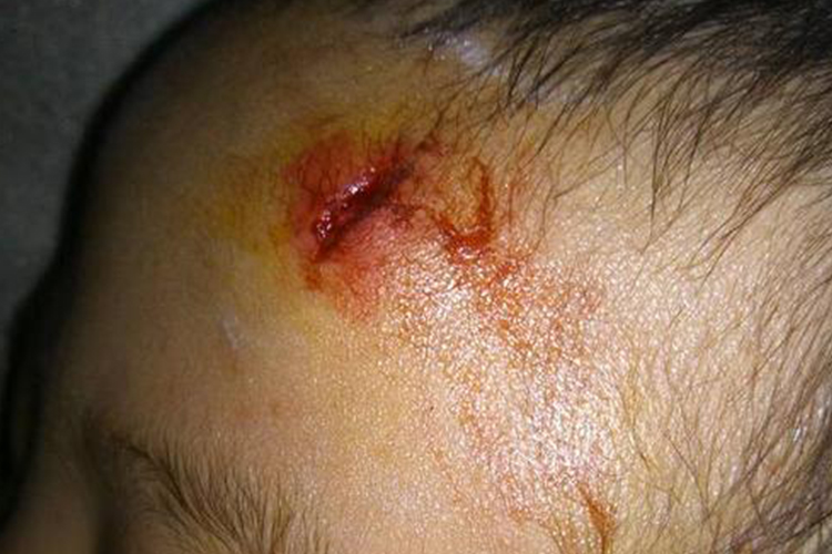 头磕破了一个小口子图