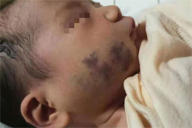 面部海绵状血管瘤