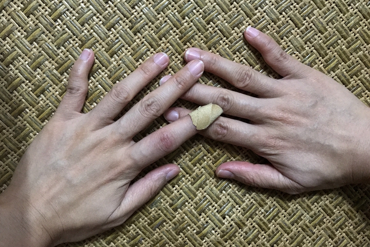 先天性小拇指弯曲图