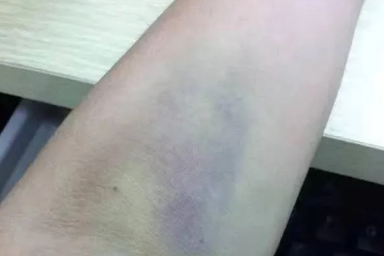 献完血手臂大片淤青图