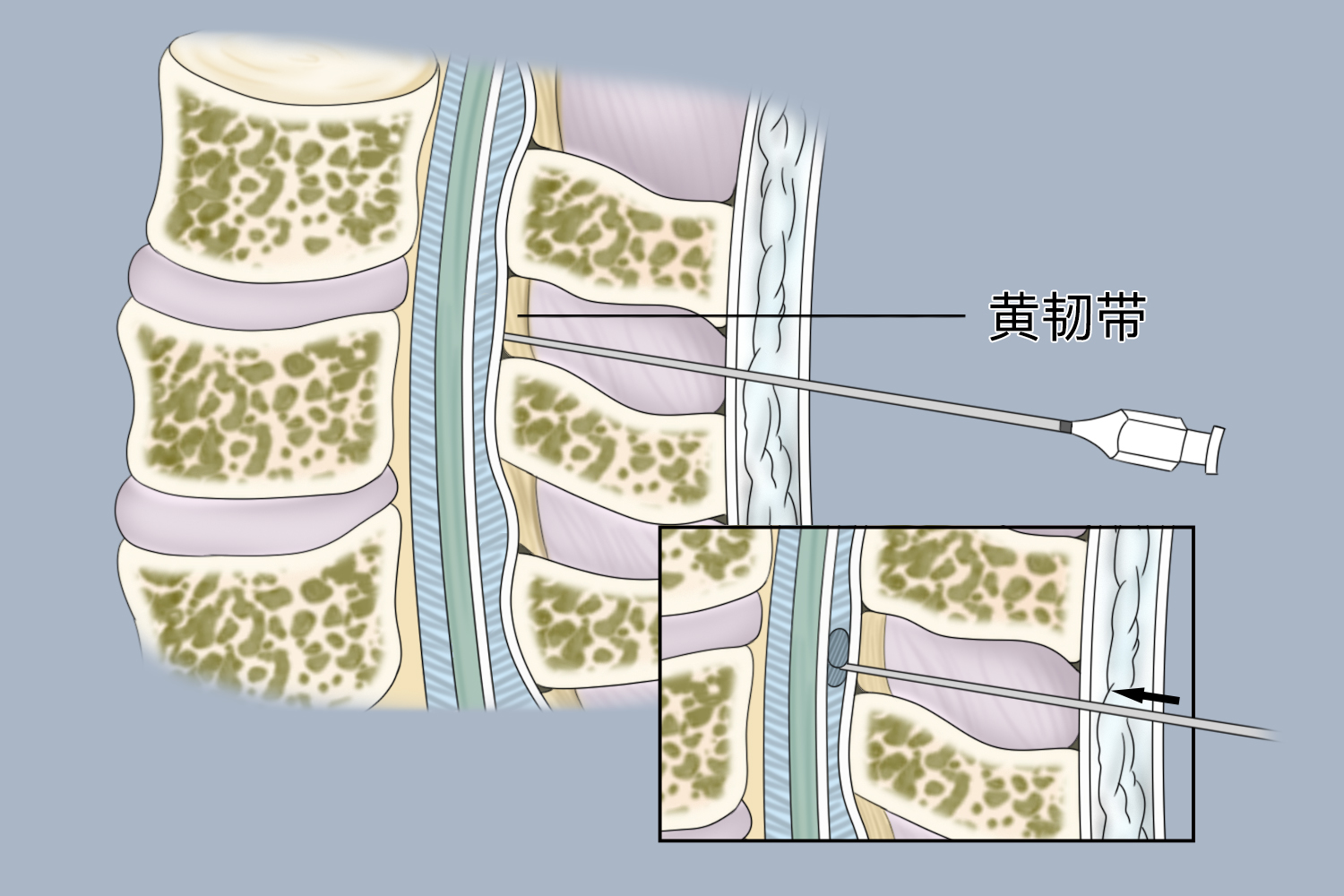 硬膜外穿刺术直入法图