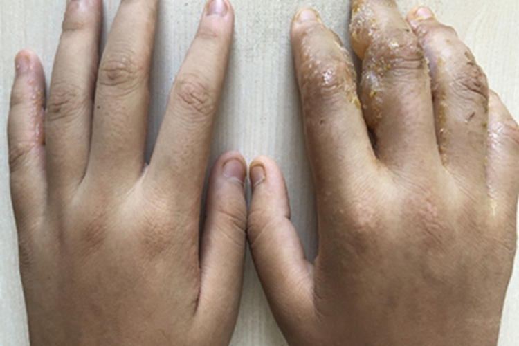 汗疱疹手指结痂图