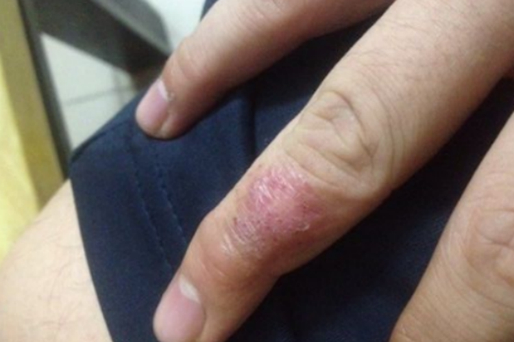 手癣和汗疱疹区别图